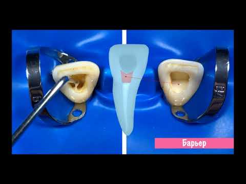 Видео: 7  Кырманов   Внутрикоронковое отбеливание