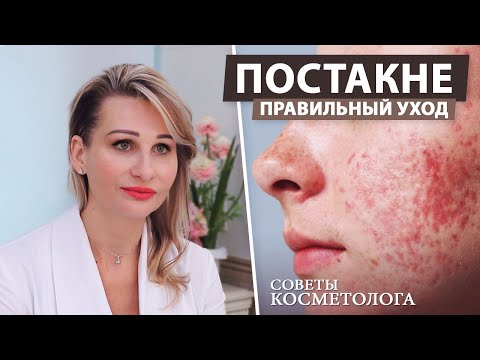 Видео: Правильный уход за кожей при постакне. Советы косметолога