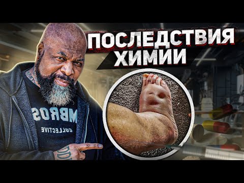 Видео: ПЛЕВАЛИ НА ЗДОРОВЬЕ РАДИ МЫШЦ / последствия анаболиков