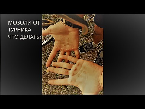 Видео: МОЗОЛИ ОТ ТУРНИКА И КАК С НИМИ БОРОТЬСЯ
