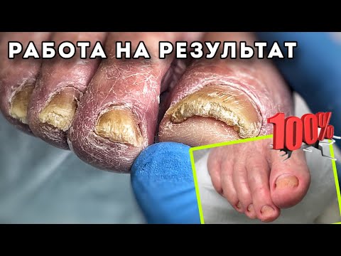 Видео: Ногти в пожилом возрасте 80+ . Состояние ногтей без должной гигиены #подологтатьянапак