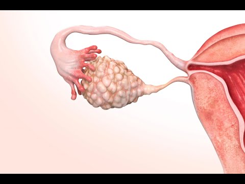 Видео: Синдром поликистозных яичников, лечение.