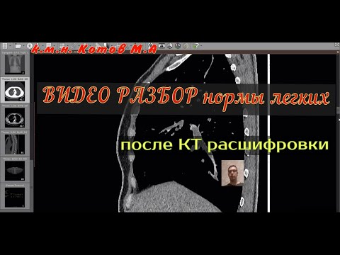 Видео: ВИДЕО РАЗБОР и оценка результатов КТ ЛЕГКИХ в норме после КТ РАСШИФРОВКИ