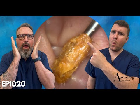 Видео: Удаление ушной серы, холестеотома ушного канала и мнение о крючке RAI - EP1020