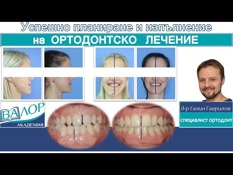 Видео: Ортодонтско-хирургично лечение на трети скелетен клас и латерогнатия. #ортодонтия #ортодонт #брекети