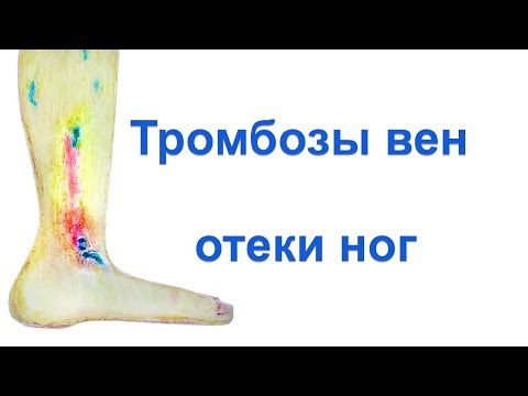 Видео: Тромбоз вен, отек ноги