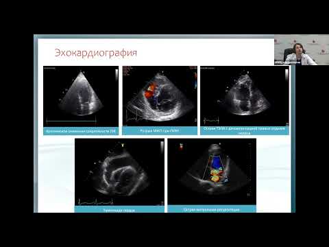 Видео: ОСН и кардиогенный шок при ОИМ Жаровин И.Н.