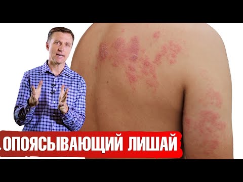 Видео: Опоясывающий лишай: что делать? Опоясывающий герпес 👉 симптомы, причины.