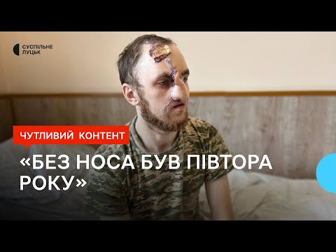 Видео: "У мене щока була вирвана, я в руках її ніс": військовому з Волині лікарі відновлюють обличчя