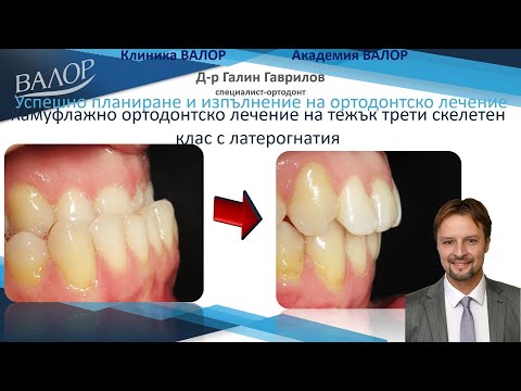 Видео: Камуфлажно лечение на тежък трети скелетен клас с латерогнатия. #ортодонтия #ортодонт #брекети