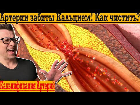 Видео: Артерии забиты КАЛЬЦИЕМ! Как убрать КАЛЬЦИНОЗ?!