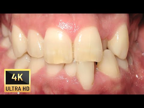 Видео: Тежко стеснение на челюстите при възрастен пациент!