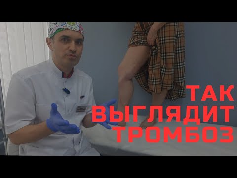 Видео: Как выявить у себя тромбоз. Флеболог Москва.