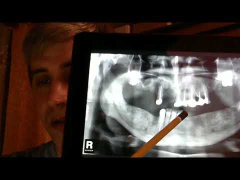 Видео: Зубные протезы день 1