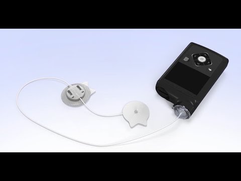 Видео: Установка инфузионного набора Sure-T