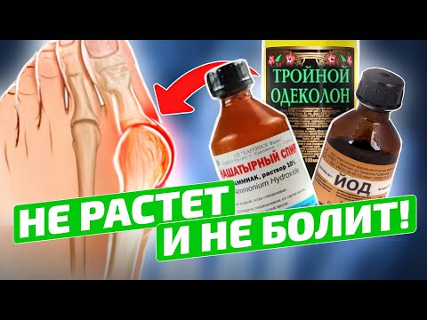 Видео: СТАРЫЙ ХИРУРГ рассказал про ЧУДО метод! И косточка на ноге расти перестала, когда я...