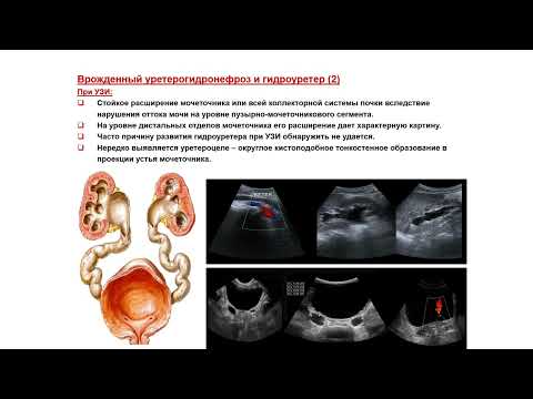 Видео: УЗИ. Доктор Иогансен. Выпуск 75. Аномалии развития почек и мочеточников. Часть 7.