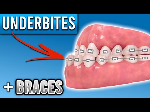 Видео: Как брекеты исправляют неправильный прикус? | Premier Orthodontics
