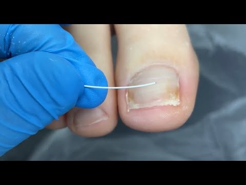 Видео: Установка новой титановой нити