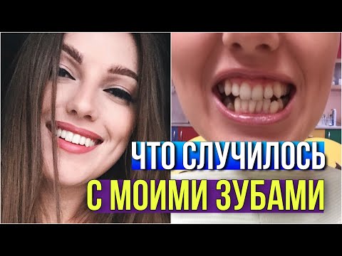Видео: 3 года ПОСЛЕ СНЯТИЯ БРЕКЕТОВ // ЧТО СЛУЧИЛОСЬ С МОИМИ ЗУБАМИ