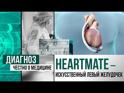 Видео: Сердце в сумке: как живут люди с искусственным сердцем | Диагноз