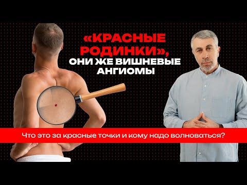 Видео: «Красные родинки», они же вишневые ангиомы. Что это за красные точки и кому надо волноваться?