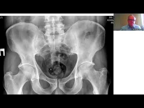 Видео: Анкилозирующий спондилит: диагностика и современные методы лечения