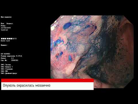 Видео: Клиническое наблюдение "Необычное наблюдение раннего рака желудка". С. С. Пирогов