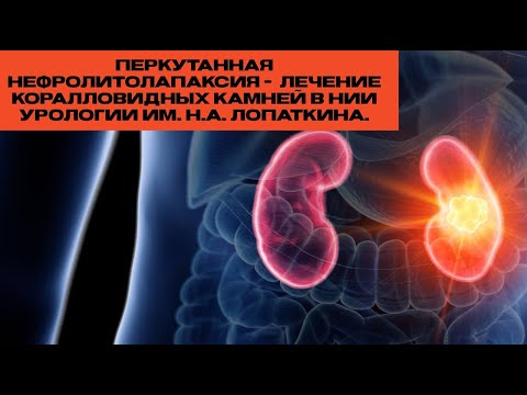 Видео: Перкутанная нефролитолапаксия -  лечение коралловидных камней в НИИ урологии им. Н.А. Лопаткина.