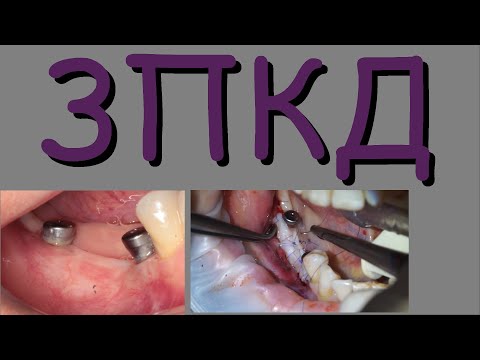 Видео: Когда мало ЗПКД.