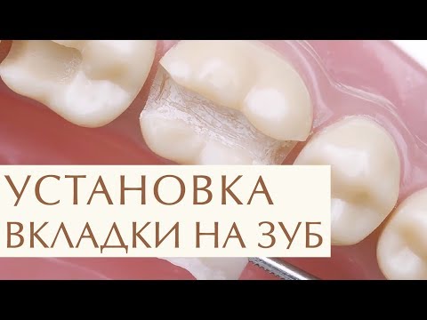 Видео: ✨  Плюсы восстановления зуба с помощью керамической вкладки. Керамическая вкладка на зуб. 12+