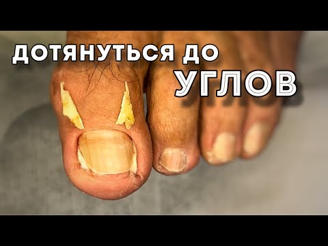 Видео: Визит к подологу неизбежно | два вросших угла