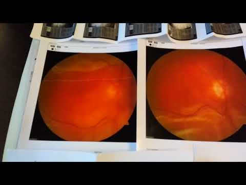 Видео: Отслоение сетчатки глаза. Исцели себя сам. Мои снимки и документы.