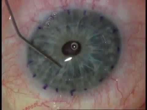 Видео: Сквозная кератопластика с помощью фемтосекундного лазера