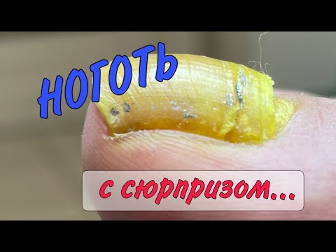 Видео: Отдавленный ноготь / отвалился ноготь / отошёл ноготь, что делать?