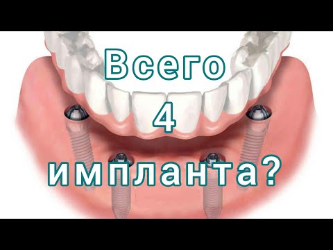 Видео: Имплантация зубов ВСЕ НА 4.  ПРОТЕЗ на 4 имплантах. НЕСЪЕМНЫЙ протез на 4 имплантах.