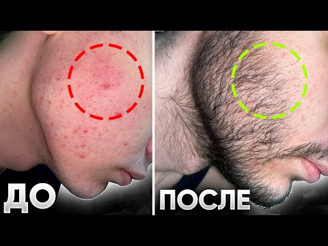 Видео: ОТРАСТИЛ БОРОДУ И ПОБОРОЛ АКНЕ / Результаты средств для роста бороды