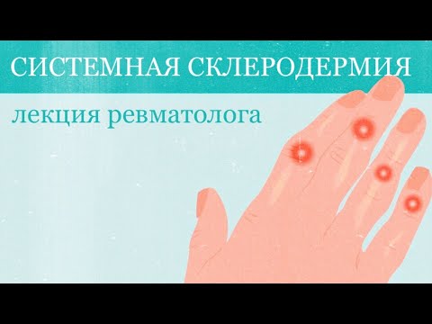 Видео: Системная склеродермия: лекция ревматолога