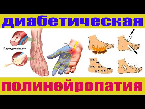 Видео: Как лечить диабетическую полинейропатию. Полная схема лечения. 99% результат.