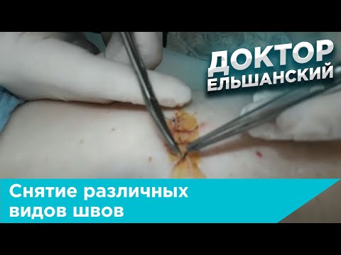 Видео: Снятие различных видов швов (по Холстеду, по Донати, по Альговеру)