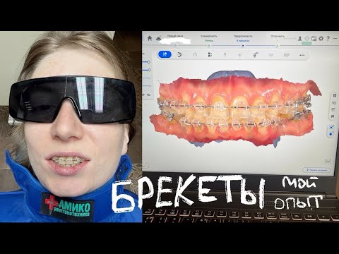 Видео: Брекеты и имплантация. Мой опыт!