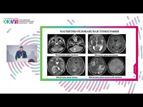 Видео: Диагностика метастатических опухолей головного мозга