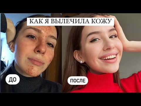 Видео: Как я вылечила АКНЕ ♥️ // чем я пользовалась // моя история // как прийти к здоровой коже лица