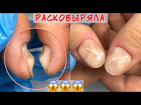 Видео: Расковыряла палец / Бугры и ямы на ногтях