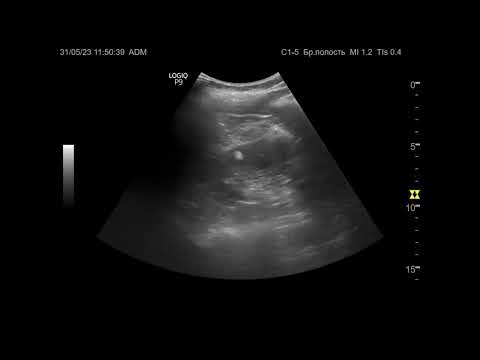 Видео: Ультразвуковая диагностика (УЗИ). Доктор Иогансен. Видеопримеры. Выпуск 37. Ангиомиолипомы почек.
