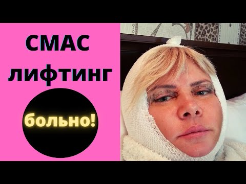 Видео: Блефаропластика и СМАС лифтинг. Личный опыт