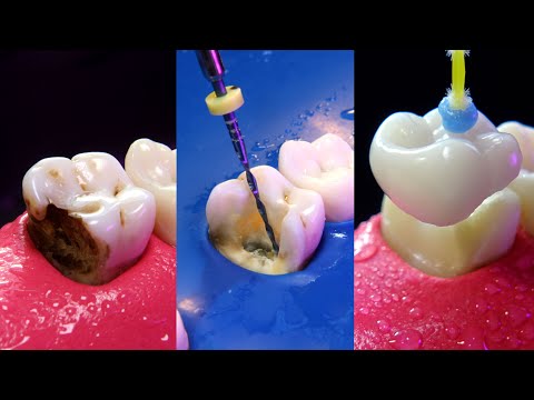 Видео: Лучшее видео о лечении корневых каналов