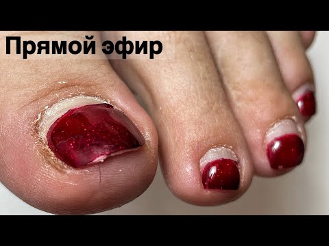 Видео: ПЕДИКЮР ПРИ ДИАБЕТЕ ОНЛАЙН. ВРОСШИЙ НОГОТЬ. Виктория Авдеева