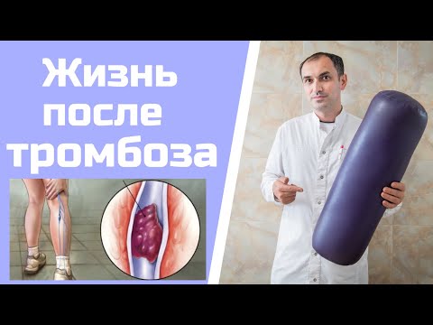 Видео: Посттромботическая болезнь. Как лечить. Флеболог Москва.