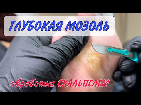 Видео: 🥕МОЗОЛЬ на ноге / как убрать мозоль / курсы подологии